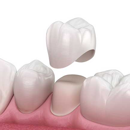Dental Crowns in Prosper