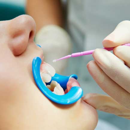 Dental Sealants in Prosper
