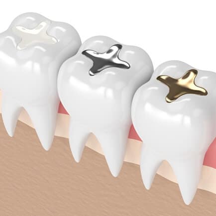 Dental Fillings in Prosper
