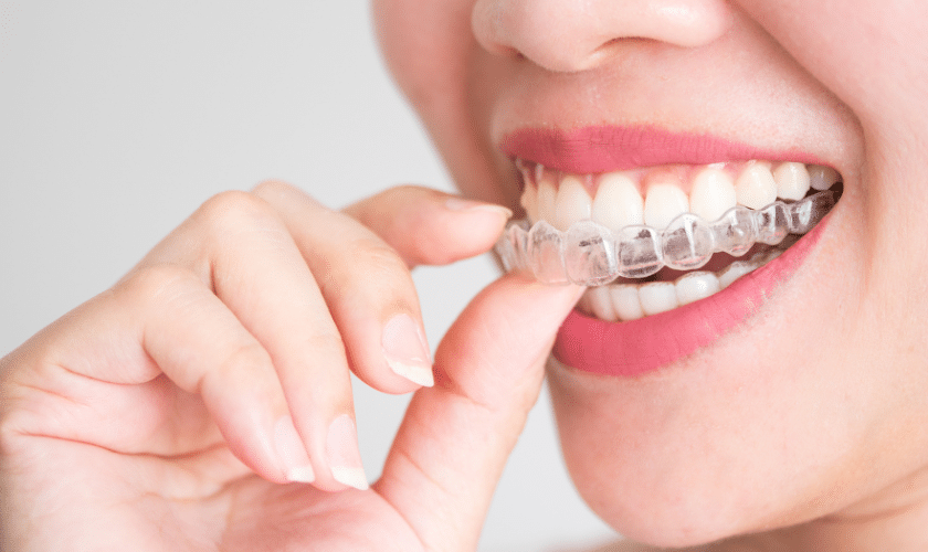 INVISALIGN IN PROSPER