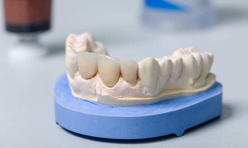Dental Crowns Prosper