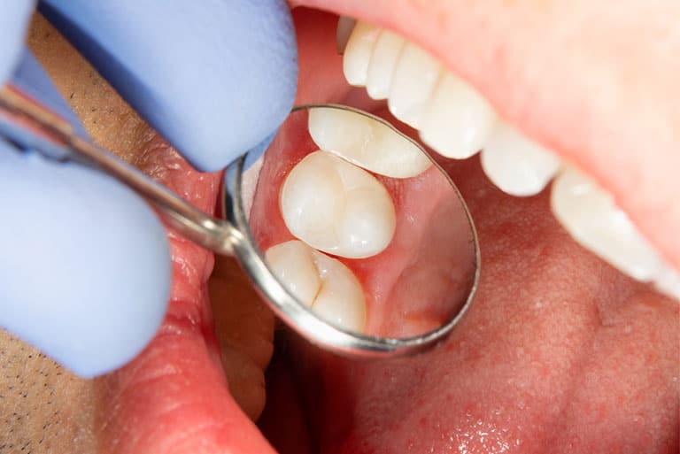 Dental Sealants Prosper