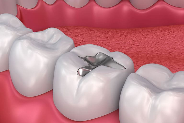 Dental Fillings Prosper