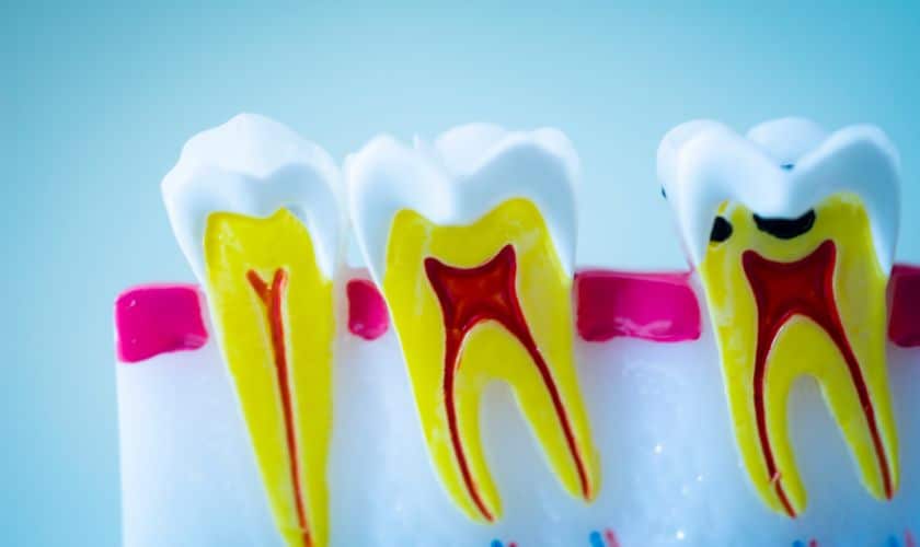Tips for Fast Healing-After a Root Canal