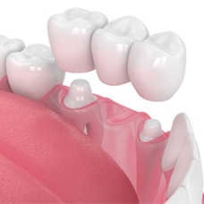 3D dental implants illustration showing white tooth crowns on pink gum model for prosthetic dentistry.