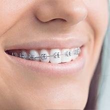 Close-up of smiling person with metal dental braces on upper teeth