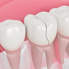 Dental crown placement illustration showing tooth restoration over pink gum background.