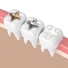 Three white tooth models with gold, silver, and clear crown options on pink gum line.