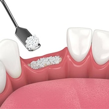 Dental tool placing bone graft material in tooth implant socket between healthy teeth.