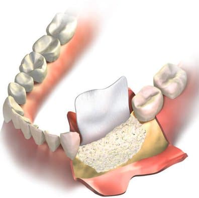 Dental implant illustration showing bone structure, implant placement, and crown restoration in jaw.