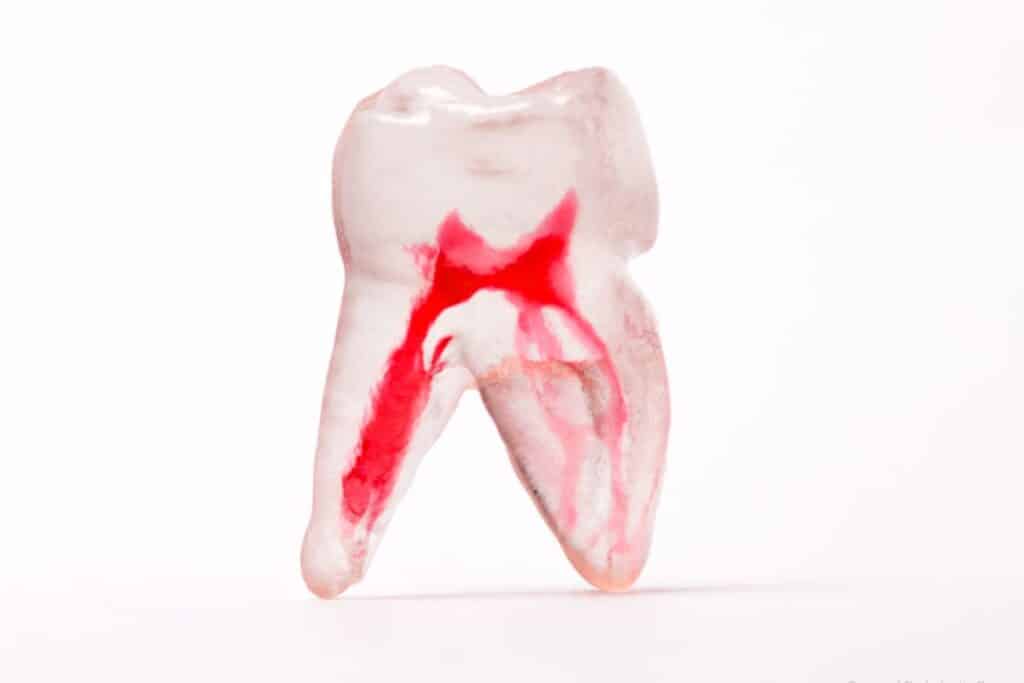 Types of Endodontic Surgery