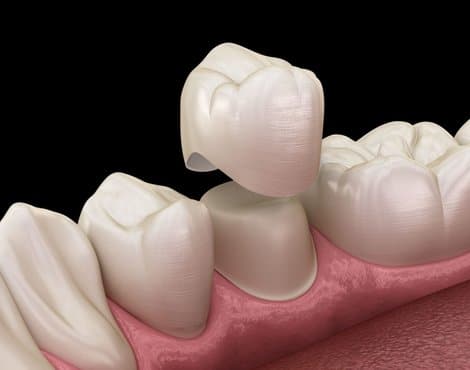 Dental crown placement illustration showing tooth restoration on gum model against black background.