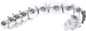 Dental braces progression showing stages of orthodontic treatment from misaligned to straight teeth.