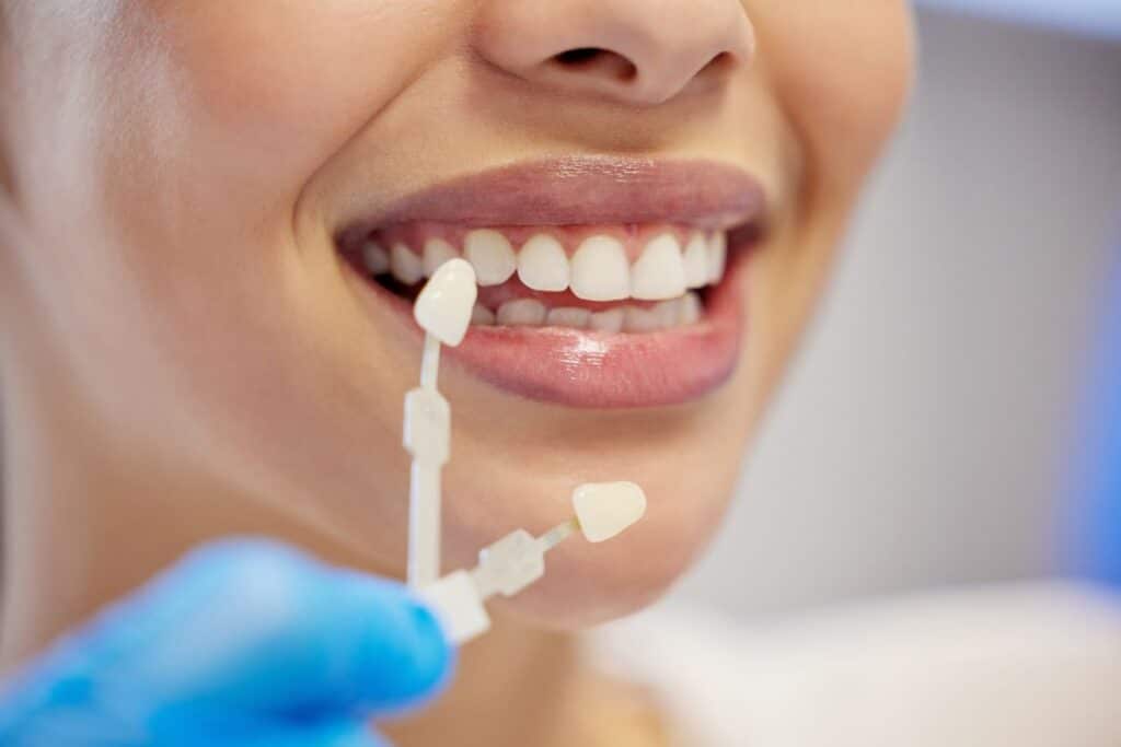 what to do if your dental veneer chips