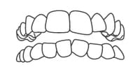 Illustration of upper and lower dental implants or dentures showing teeth alignment and bite relationship.
