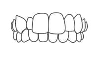 Dental prosthetics diagram showing full upper and lower tooth crowns or dentures alignment.