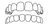Dental illustration showing upper and lower teeth alignment and bite in black outline format.