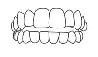 Dental illustration showing upper and lower teeth alignment and bite for orthodontic or cosmetic dentistry reference.