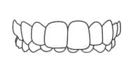 Dental prosthetic model showing full upper teeth alignment and structure for orthodontic or cosmetic dentistry treatment.