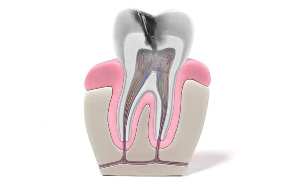 How Long Do Teeth Last After Endodontic Treatment