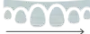 Dental arch diagram showing teeth alignment with measurement arrow for orthodontic assessment.