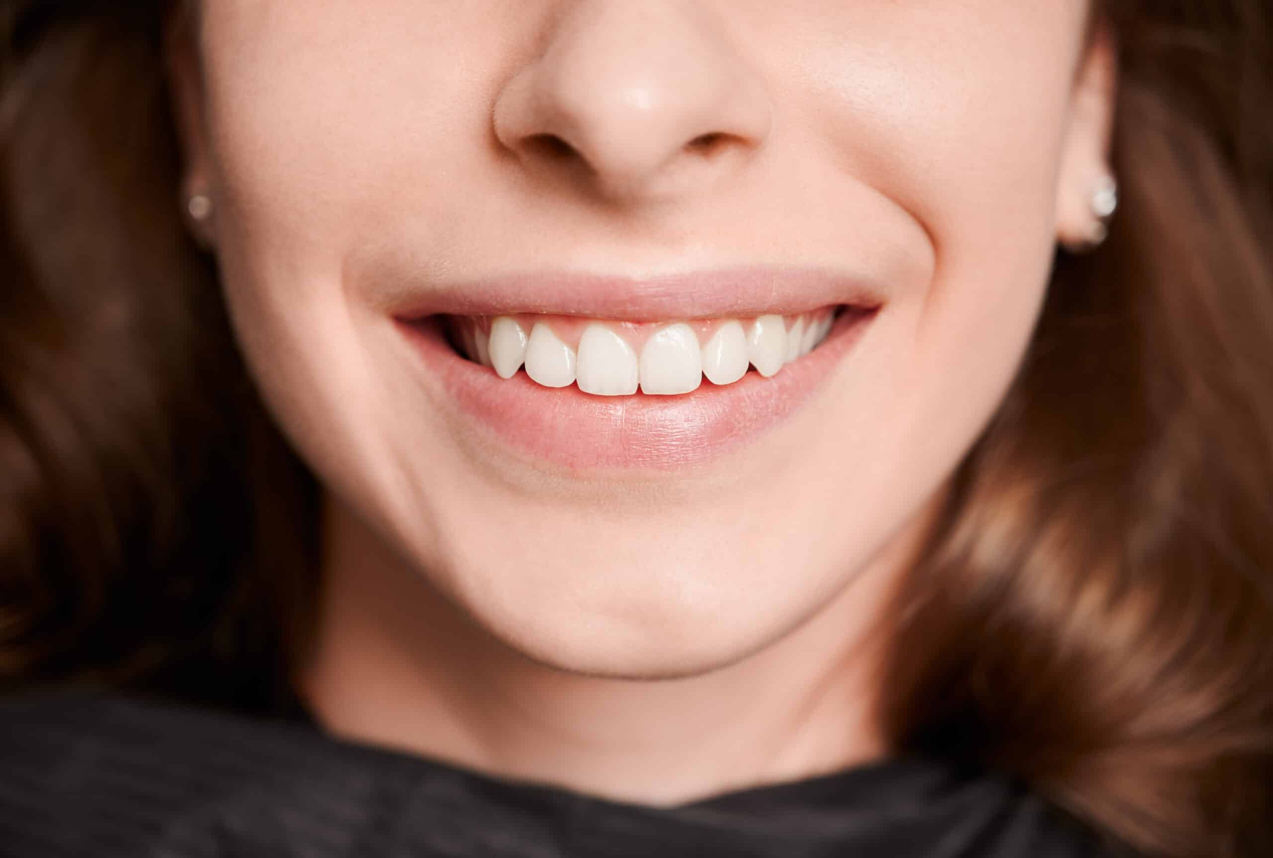 What Are the Options to Fix Uneven Smiles?