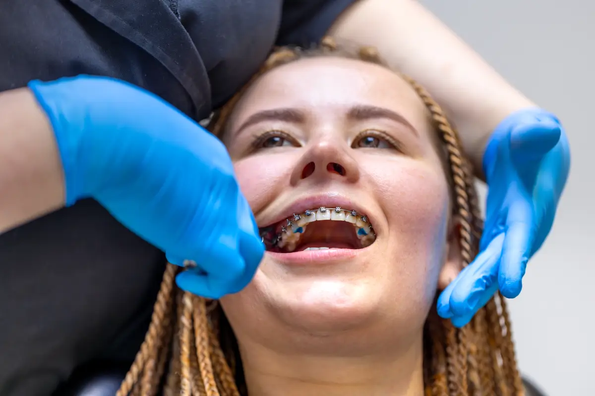 Can Teeth Shift Years After Braces? Expert Guide