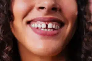 Close-up of a smiling woman showing a visible gap between her front teeth.